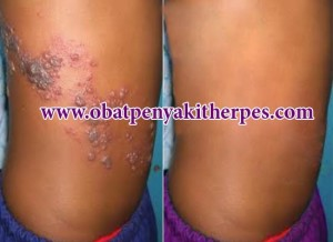 Illustration for article titled Obat Penyakit Herpes Kulit
